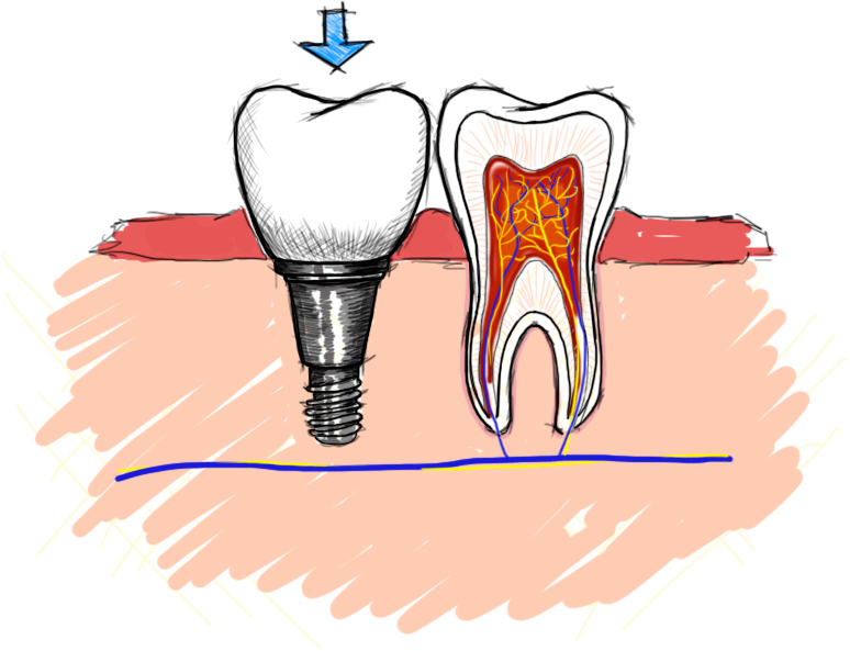 インプラント（人工歯根）